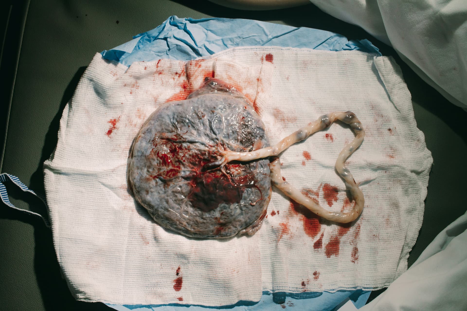 Placenta prepared for encapsulation after birth